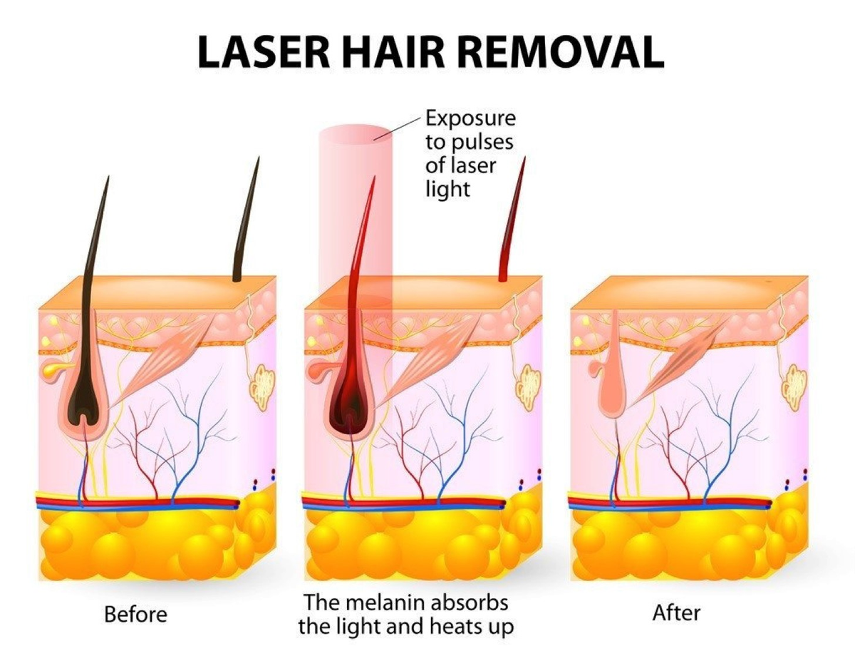 Laser proces